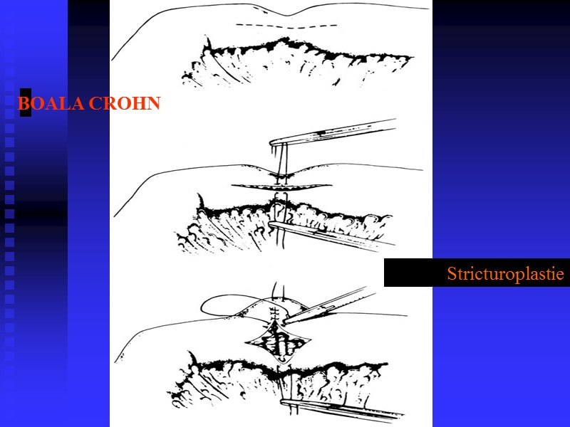 Stricturoplastie BOALA CROHN